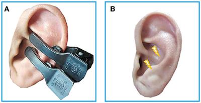 Transcutaneous Auricular Vagus Nerve Stimulation Modulates the Prefrontal Cortex in Chronic Insomnia Patients: fMRI Study in the First Session